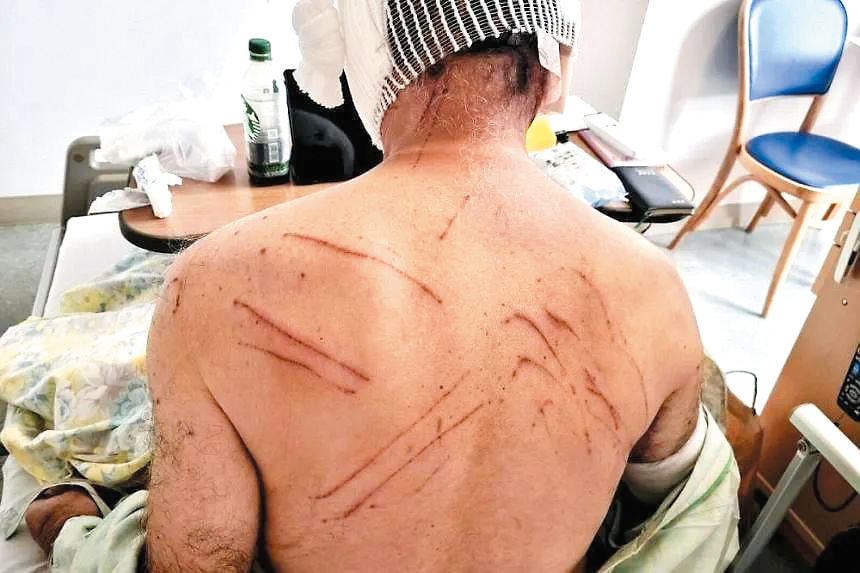 秋田縣一名男子在熊爪下僥倖逃脫，但背部滿是爪痕。