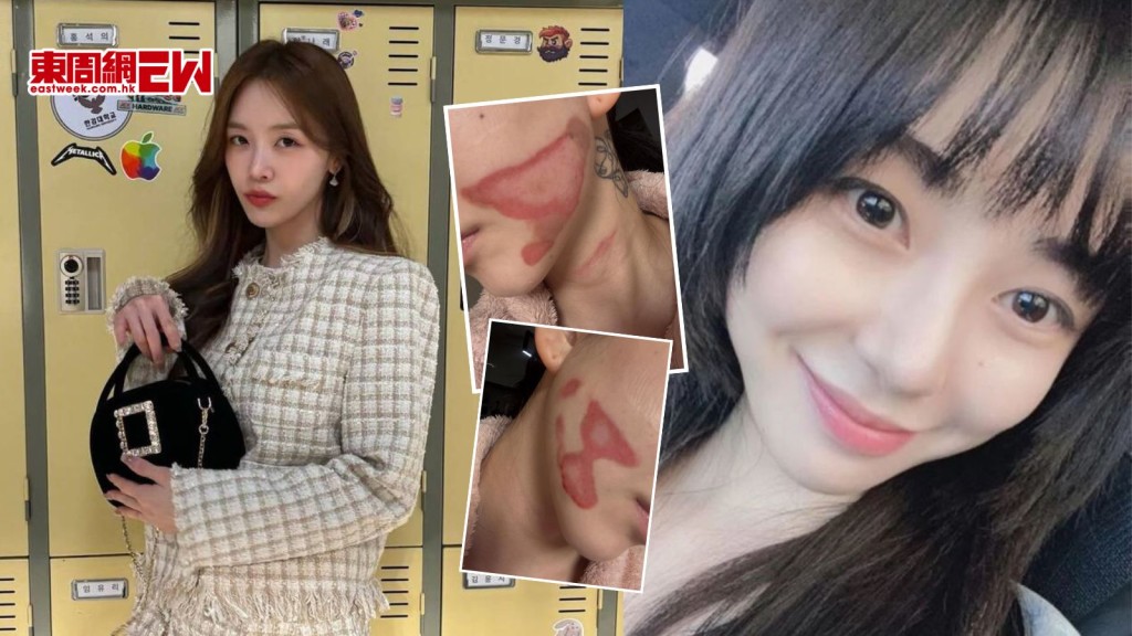 AOA前成員權珉娥做醫美被毀容 面部二級灼傷崩潰痛哭恐留疤 曾遭欺凌致抑鬱多次輕生