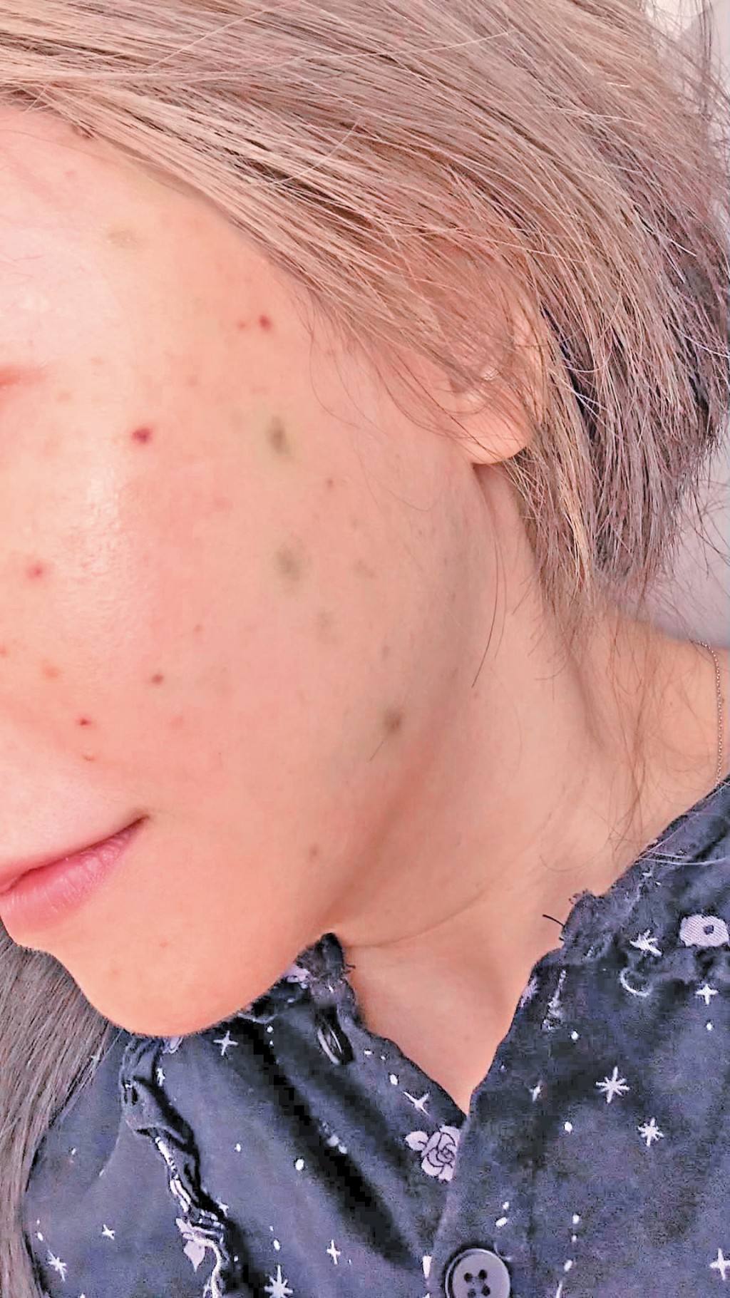 網上有曾注射Re2O針劑的用家指，注射針劑三天後臉上仍留有「蚊子包包」的傷口痕跡。