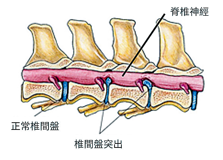 椎間盤突出症（Intervertebral Disc Disease, IVDD）是犬類常見的脊椎疾病。