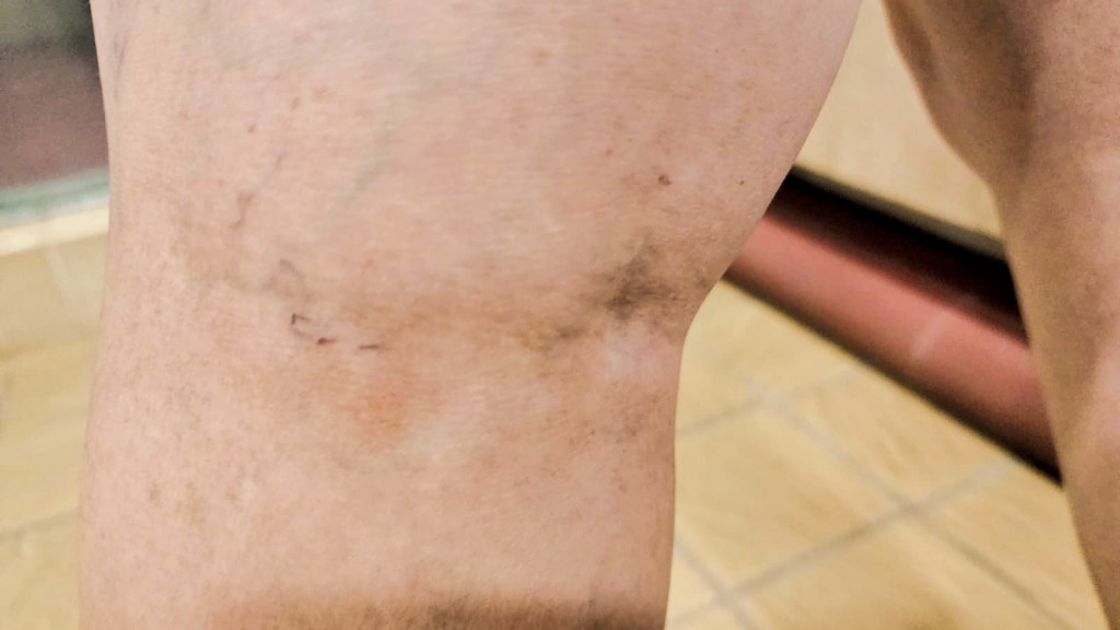 陳太發現使用紅光產品後,後膝有瘀傷出現。圖為瘀傷出現一星期後所拍攝。 陳太發現使用紅光產品後,後膝有瘀傷出現。圖為瘀傷出現一星期後所拍攝。