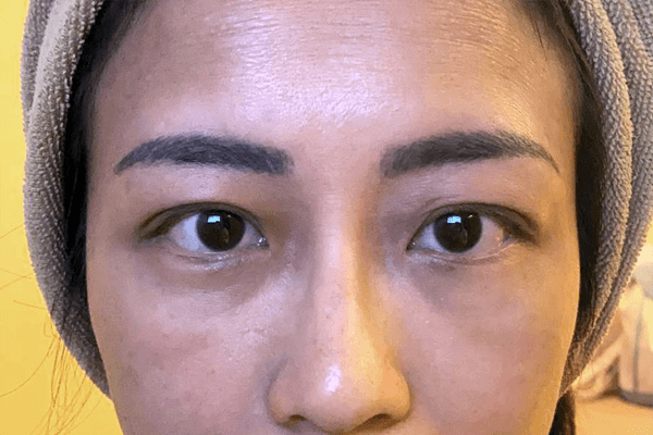 療程後眼底明顯更平滑緊緻，眼袋、黑眼圈顯著減淡。