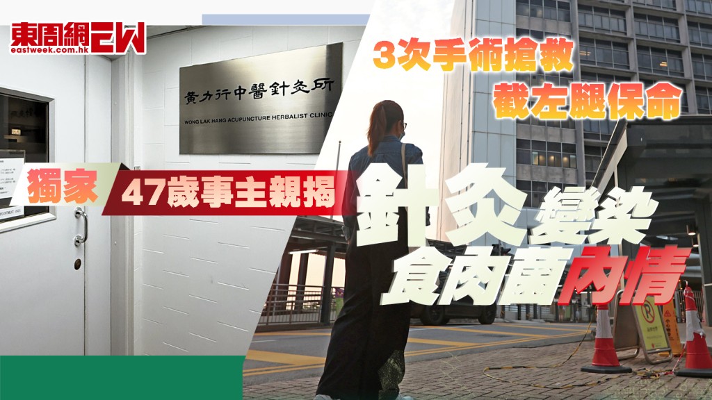 家︱47歲事主親揭　針灸變染食肉菌內情 3次手術搶救　截左腿保命︱新一期《東周刊》精彩預告