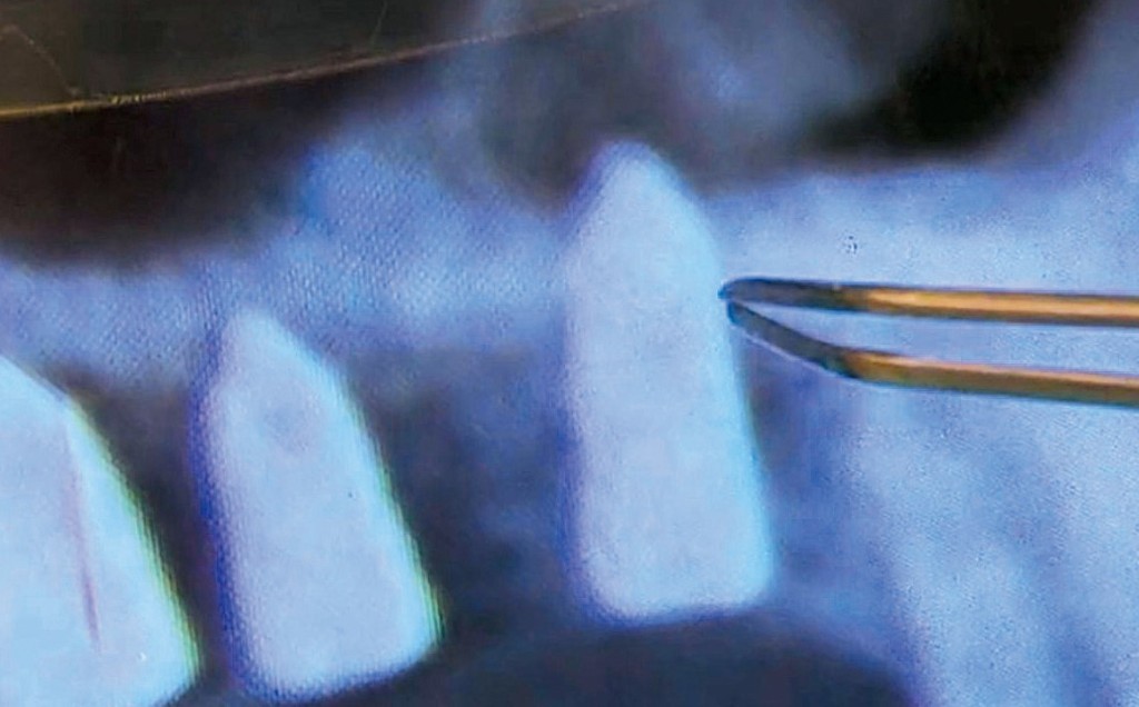 有港人在內地接受種牙手術後，發現鼻竇被刺穿。