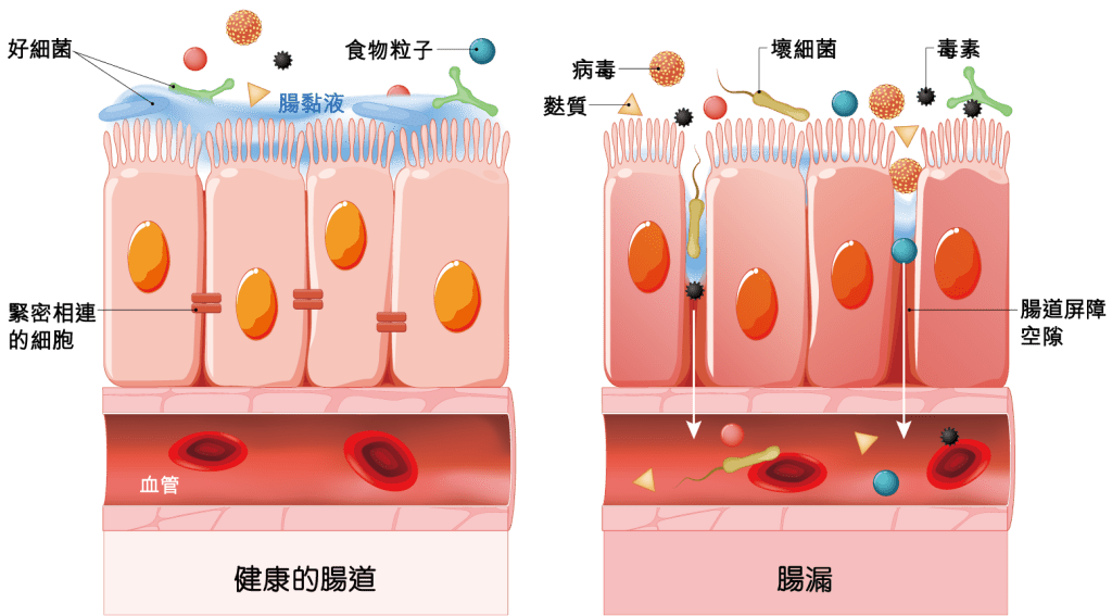 近年不少臨床研究發現,腸道微生態失衡與多種皮膚疾病有密切關係。維持良好的腸道微生態平衡,就可調節身體抗發炎的反應。 近年不少臨床研究發現,腸道微生態失衡與多種皮膚疾病有密切關係。維持良好的腸道微生態平衡,就可調節身體抗發炎的反應。