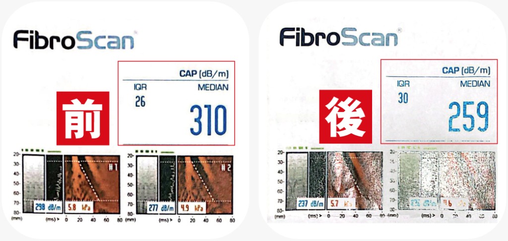 病人在服用益生菌前的CAP指數是310，三個月CAP指數回落至259，肝脂由重度降至輕度。