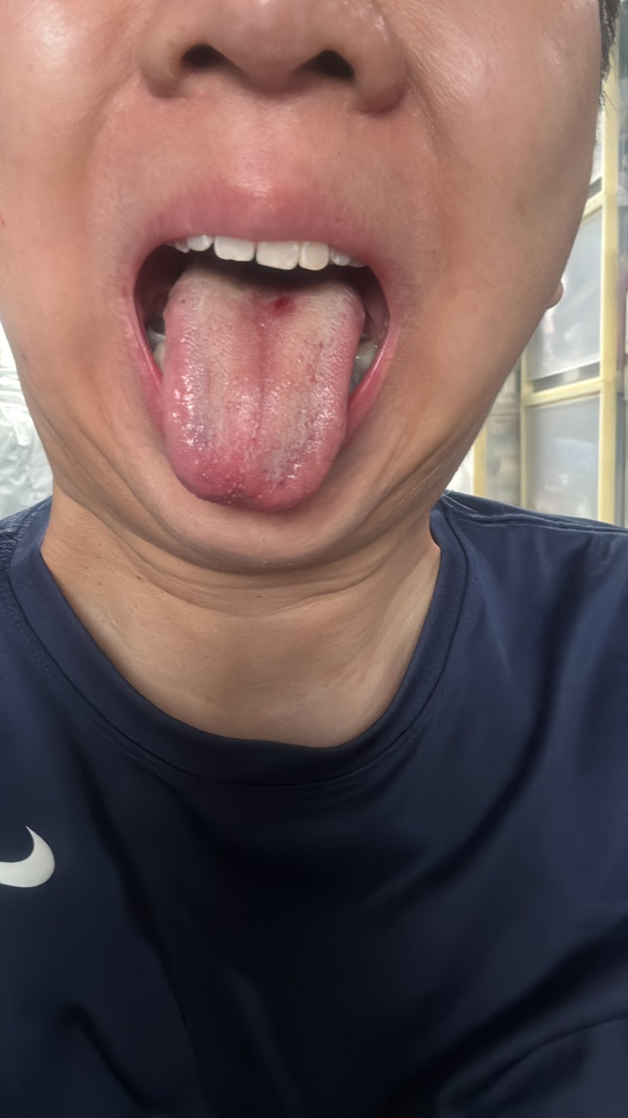 網民食燒賣食到針狀物，慘遭刺傷。