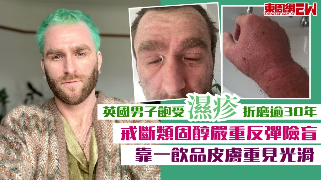 濕疹折磨逾30年！男子戒斷類固醇嚴重反彈險盲！靠一飲品皮膚重見光滑！