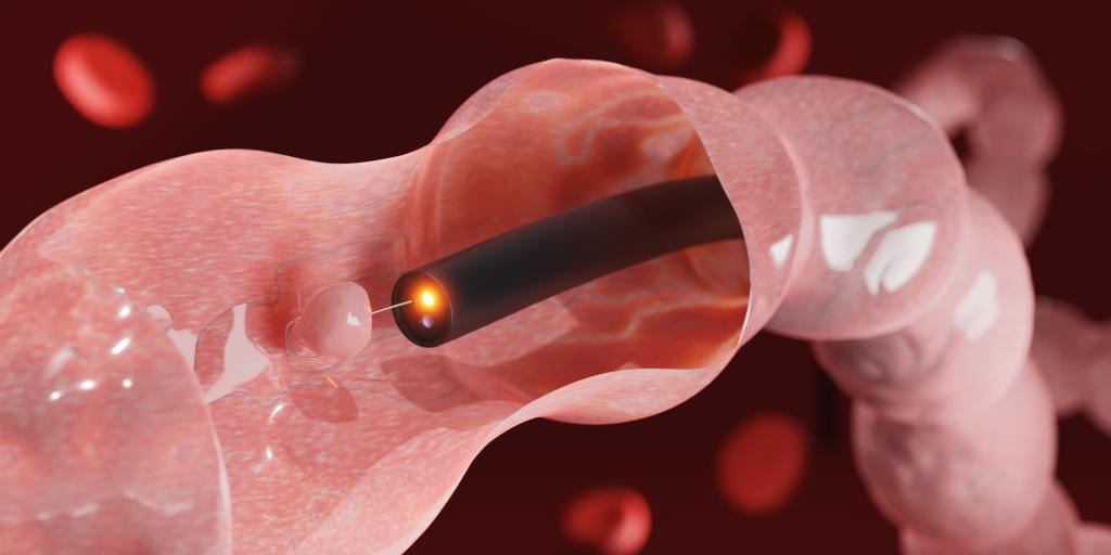 大腸鏡檢查可直接觀察腸道內壁，並可按情況抽取組織化驗或切除瘜肉，有助及早發現及處理病變。