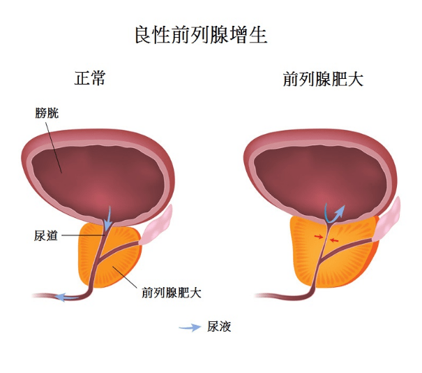 前列腺增生(圖右)壓着尿道(白圈)導致排尿困難。