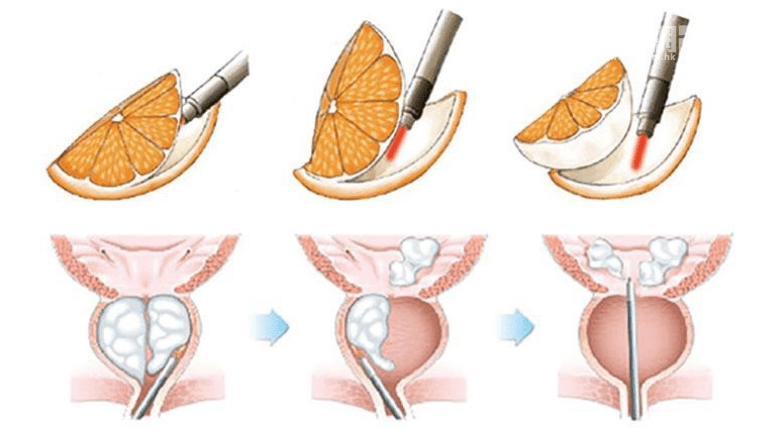 前列腺剜除術的做法就像剝橙皮一樣，橙皮就等於其壁膜，而橙肉就是前列腺組織，將橙肉與橙皮分離，徹底取走前列腺。