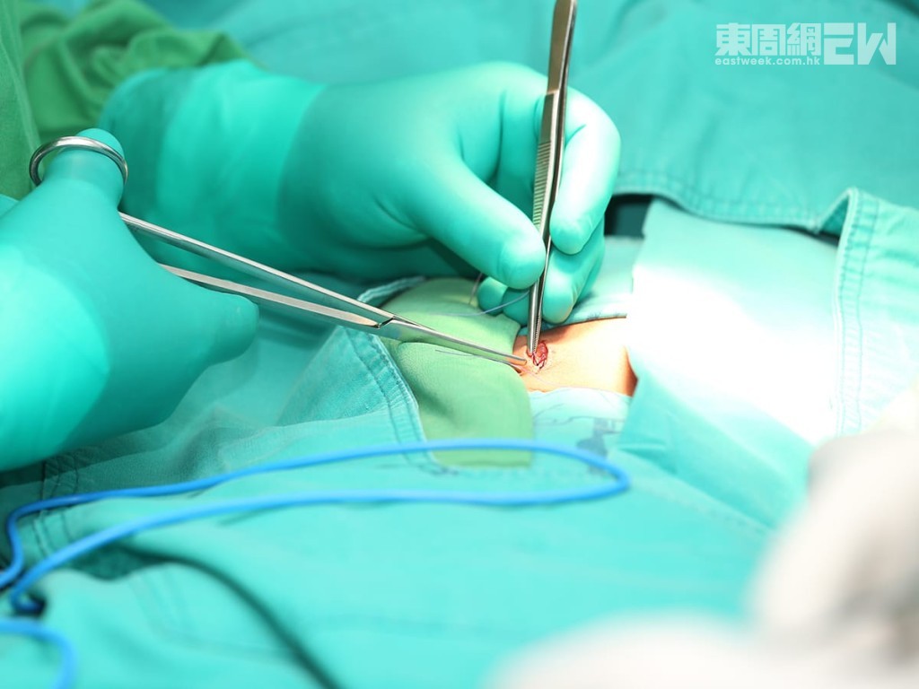 傳統開放式手術的做法是使用鋼線將患病血管整條抽出，傷口較大可能會有受細菌感染風險。