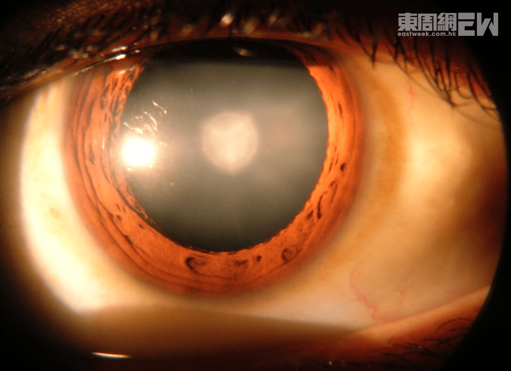 患有白內障的眼睛，晶體中間變得混濁，如有一層白膜，令視力變得模糊。