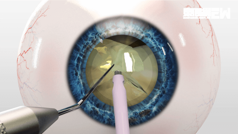 手術時只需麻醉眼球表面，後用吸管將晶體溶解並抽出，再植入人工晶體便完成。