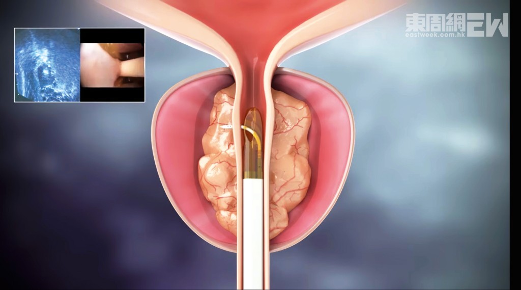 2.儀器經尿道進入