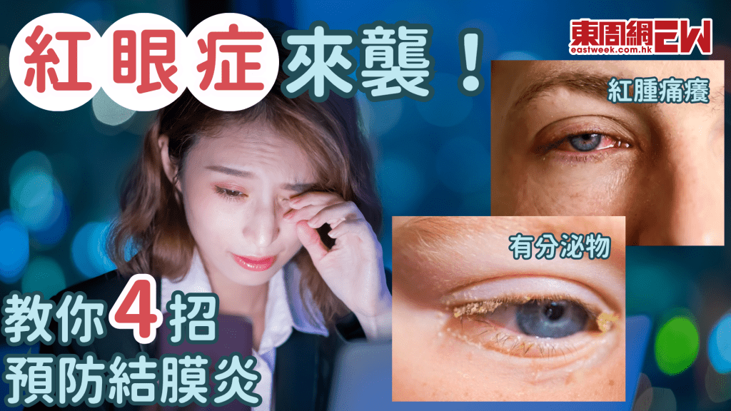 紅眼症來襲 你做好防範未？│康健講健康