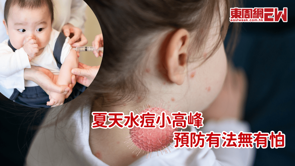夏季水痘小高峰 兒童易受感染 接種疫苗可免疫│康健講健康