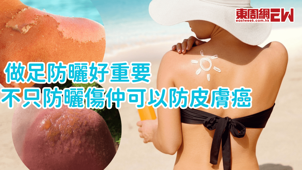 防曬好重要!UVA和UVB有甚麼分別?暴曬會生皮膚癌?