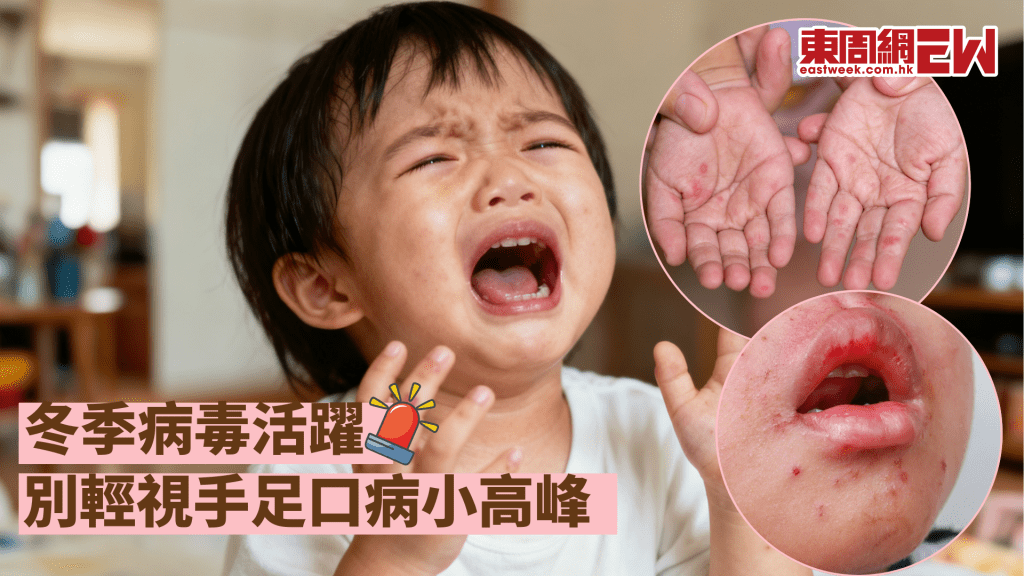 冬季病毒活躍 別輕視手足口病小高峰│康健講健康