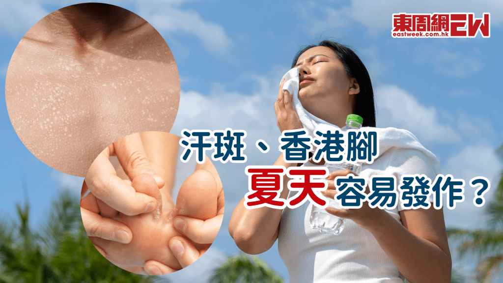 香港腳、汗斑夏天易出現？ 汗斑真的難根治？│康健講健康