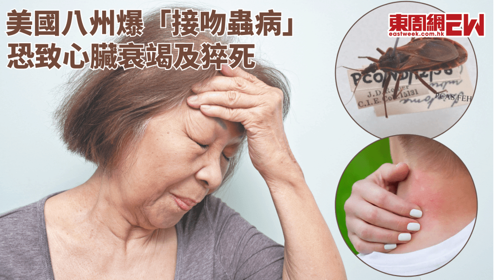 美國八州爆「接吻蟲病」恐致心臟衰竭及猝死│康健講健康