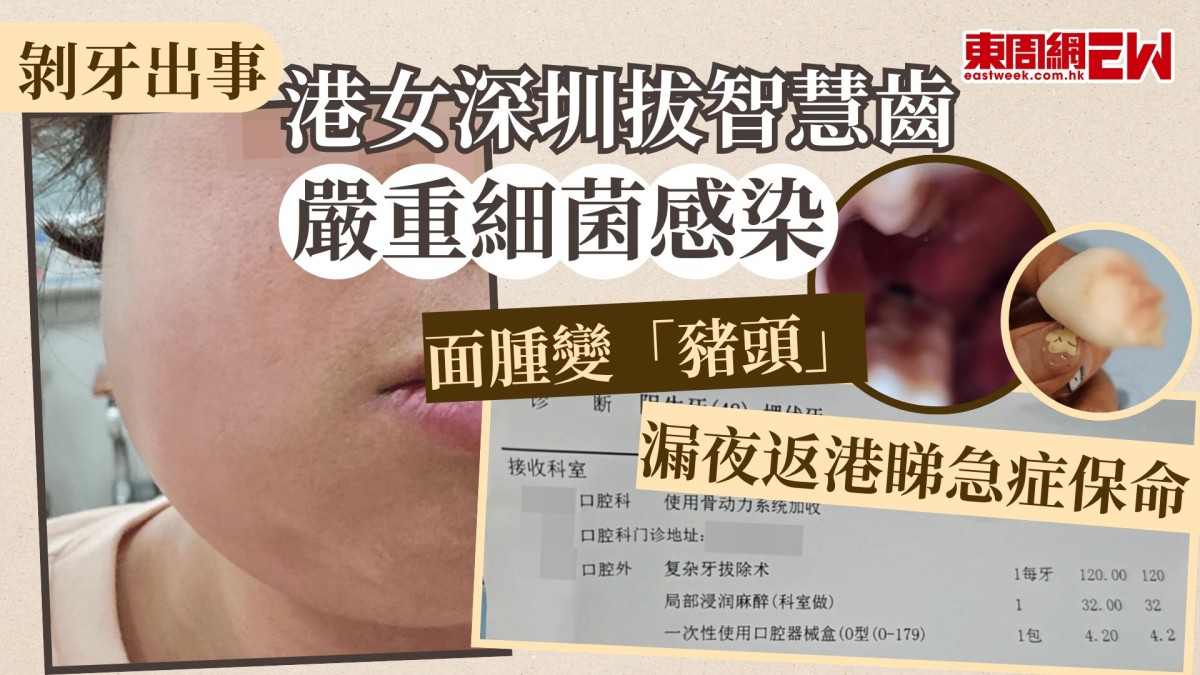 剝牙出事｜港女深圳拔智慧齒嚴重細菌感染  面腫變「豬頭」 漏夜返港睇急症保命